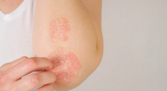 Eczéma : comprendre, apaiser et prévenir les crises naturellement