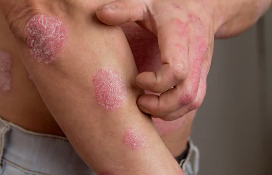 Psoriasis : comprendre cette maladie de peau et apaiser les symptômes au naturel
